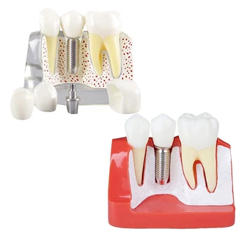  Демонстрационная модель зубов Имплантат Съемный анализный коронный мост для общения с пациентом