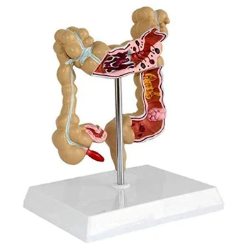 Модель патологического колоректального рака толстой кишки Модель толстой кишки Анатомическая модель желудочно-кишечного тракта
